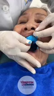 60 yaşındaki bir kadın, kaybettiği tüm dişlerinin uzman bir diş hekimi tarafından yenilenmesinin ardından aynada gördüğü inanılmaz değişim karşısında büyük bir şaşkınlık yaşadı.