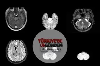 Tıbbi görüntüleme yapay zekasında veri kıtlığı bir numaralı engel teşkil ediyor. Biz ise bu soruna açık kaynaklı bir çözüm geliştirdik. NV-Generate-CTMR, gerçek hasta verilerine ihtiyaç duymadan daha dayanıklı modeller eğitebilmeniz için eşleştirilmi