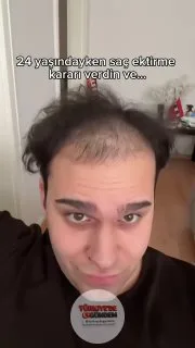 Saç ekimi yaptıran genç adam, 4 ayda yaşadığı değişimi paylaştı.