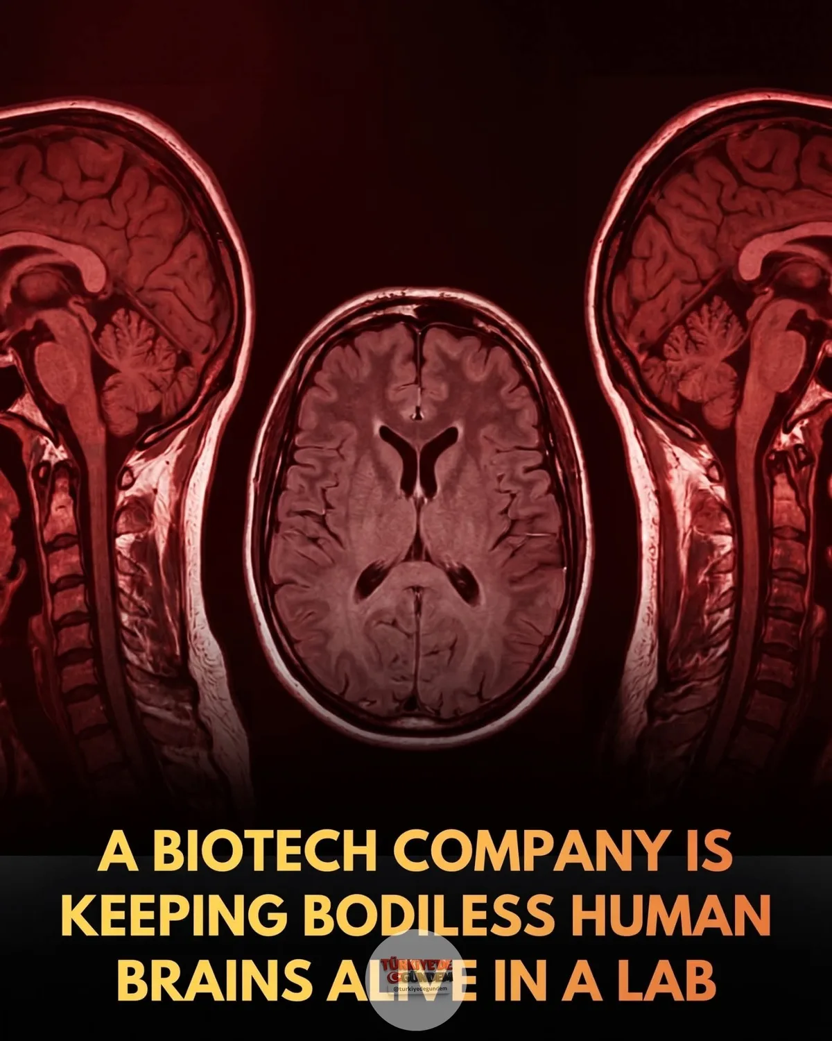 1-) 🏥 Bir biyoteknoloji şirketi, yakın zamanda hayatını kaybetmiş insan beyinlerini yüksek teknolojili bir yaşam destek ünitesinde canlı tutuyor. Şirket, bu çalışmanın nörolojik ilaç testlerinde hayvan deneylerinin olmadığı bir dönemin önünü açmayı a