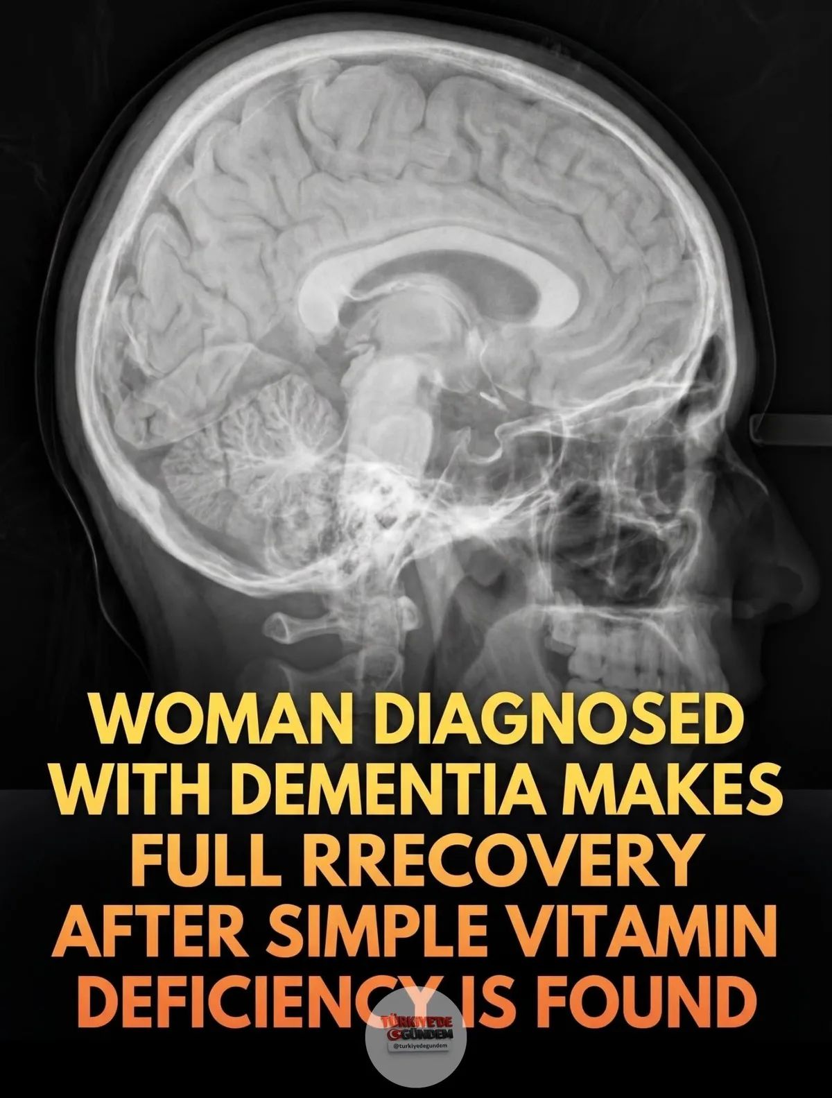 1-) 🏥 Basit bir beslenme değişikliği, demans benzeri gerilemeyi tamamen tersine çevirebilir. BMJ Case Reports'ta yayımlanan bir tıbbi vaka raporu, beş yıl boyunca yanlışlıkla demans teşhisiyle yaşayan 61 yaşındaki bir kadının çarpıcı iyileşme sürecin