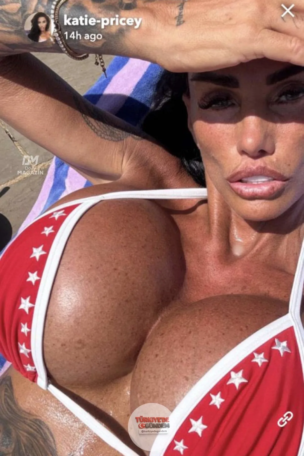 Eski model Katie Price, dudaklarına yaptırdığı son işlemle birlikte 43. estetik operasyonunu geçirdi. Price'ın daha önce 17 kez göğüs büyütme ve 7 kez yüz gerdirme ameliyatı olduğu biliniyor.