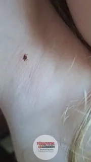 Bir anne, çocuğunu ısıran keneyi herhangi bir alet kullanmadan eliyle çıkardı.