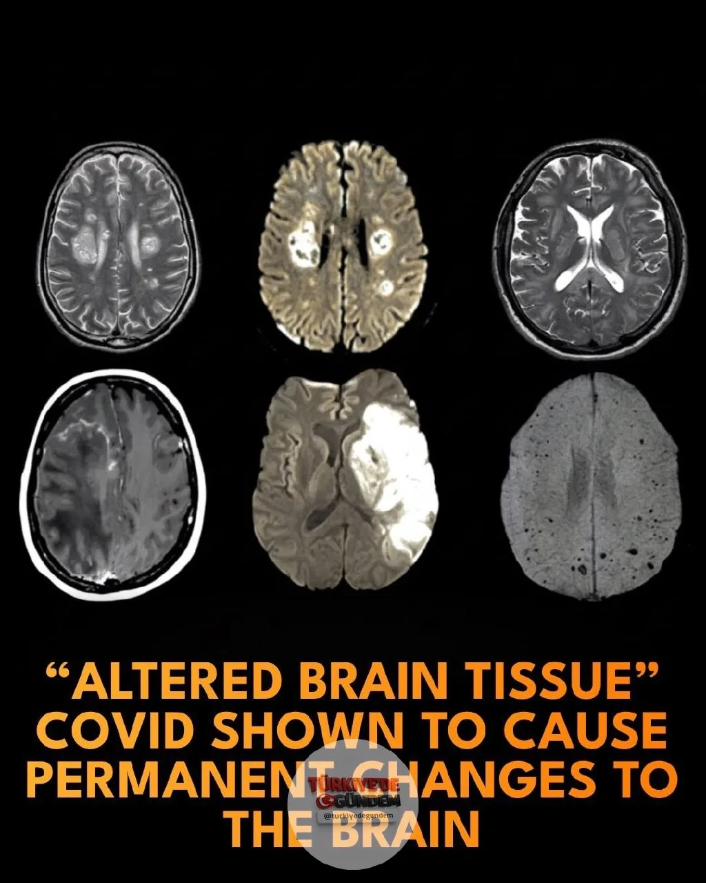 1-) 🏥 Yeni bir MRI çalışması, COVID-19'un "tam" iyileşme sağlandıktan sonra bile beyinde kalıcı değişiklikler bırakabildiğini ortaya koydu. Griffith Üniversitesi Ulusal Nöroimmünoloji ve Gelişen Hastalıklar Merkezi'nden araştırmacılar, COVID-19'u atl